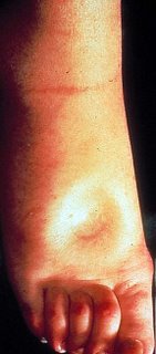  Nephrotic_Syndrome (7).jpg